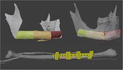 Realizing in-house algorithm-driven free fibula flap set up within 24 hours: a pilot study evaluating accuracy with open-source tools